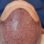 Automated scheduling software for hair transplant clinics